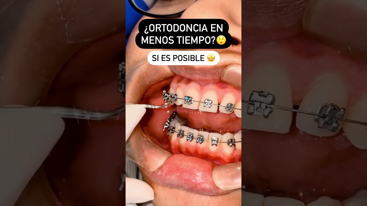 Brackets Autoligantes: La Mejor Alternativa a los Brackets Tradicionales