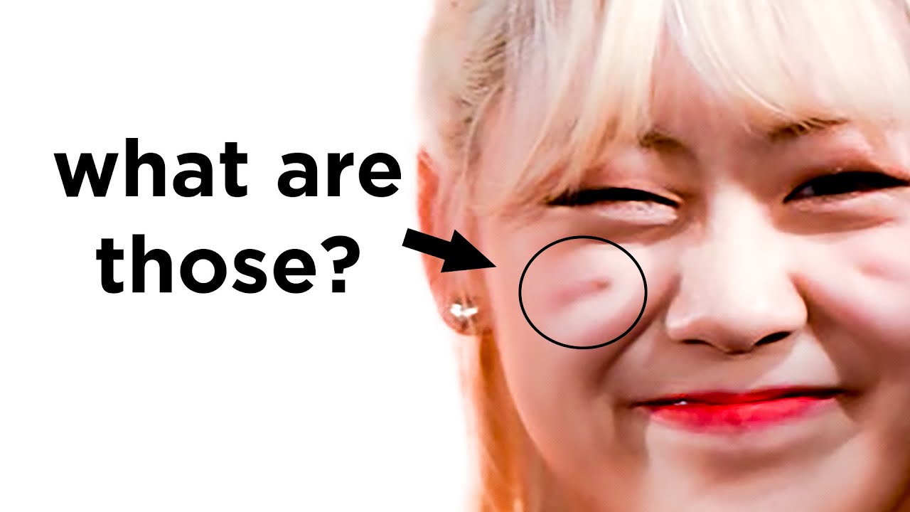 What Are Indian Dimples? Exploring + treating malar grooves #plasticsurgery #indiandimples #undereye