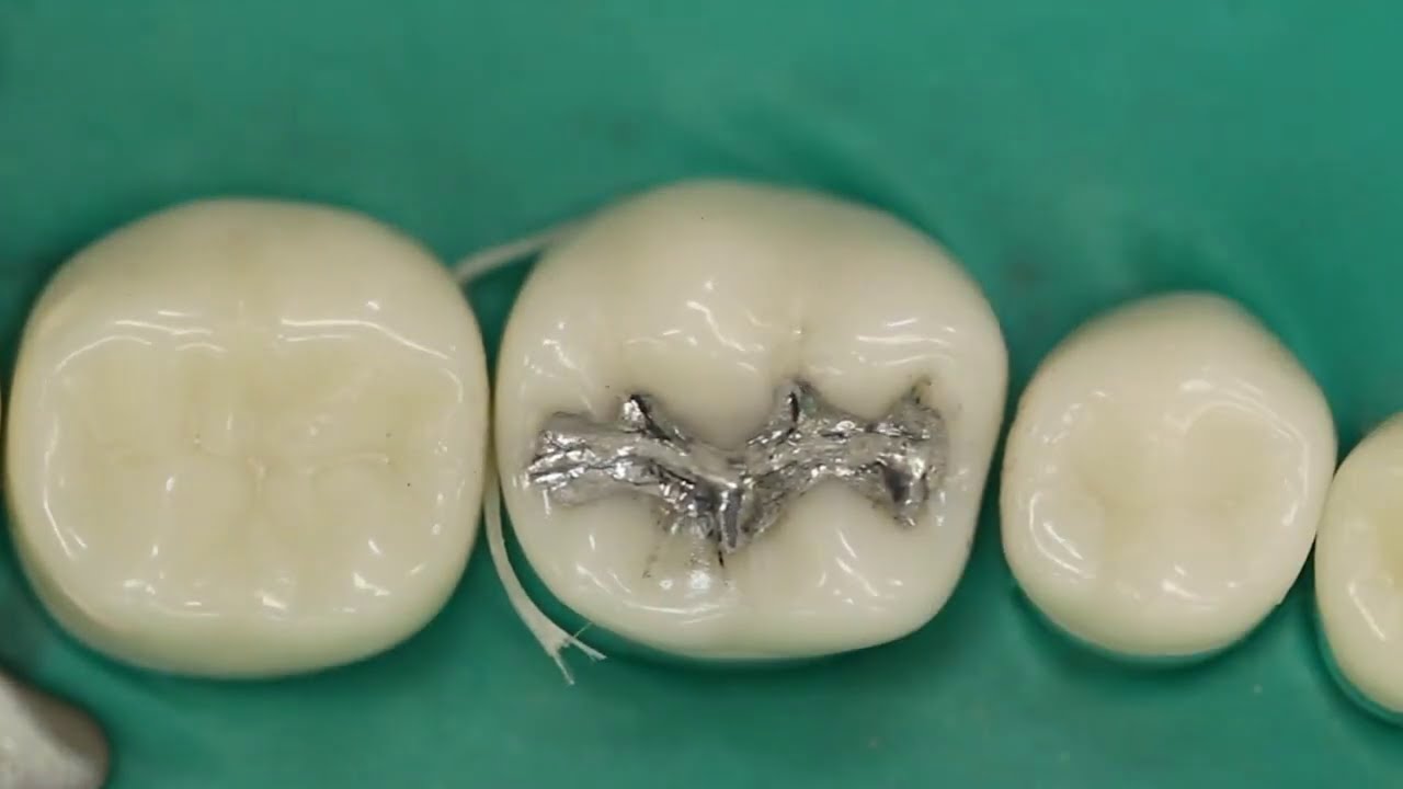 Class 1 Amalgam Restoration
