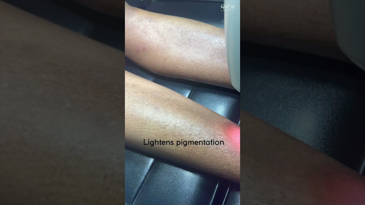 Depigmentation