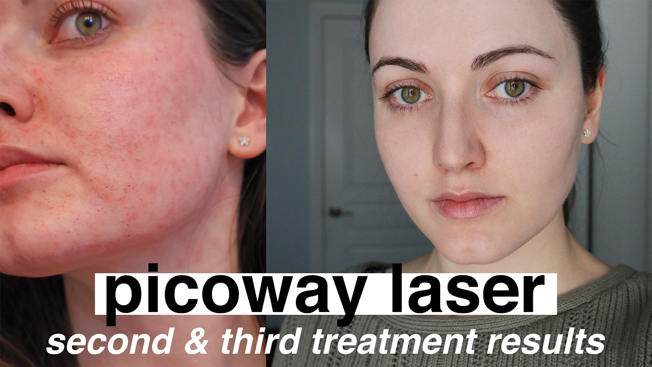 Worth It After Three Treatments? – PicoWay Resolve for Sunspots