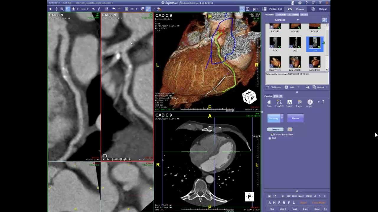 Cardiac CT Angiography Case Review Webinar 10-19-11