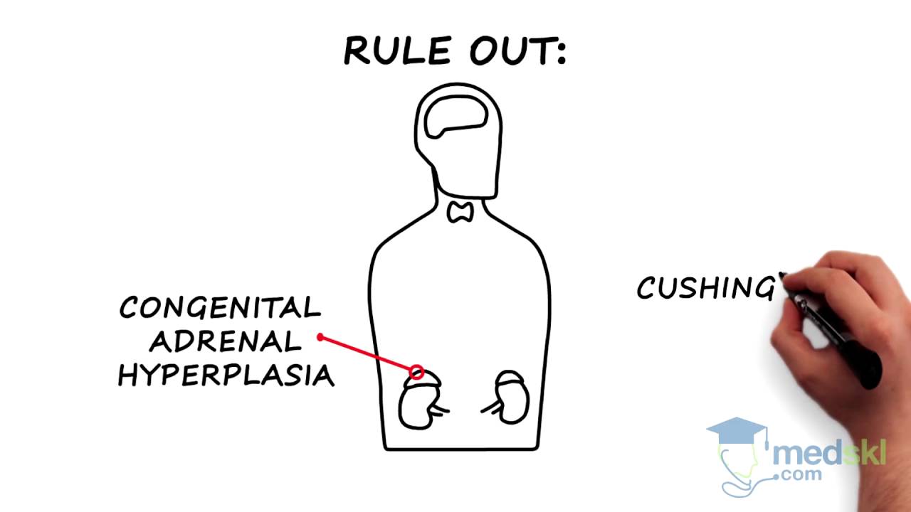 Endocrinology - Hirsutism and Hypertrichosis: By Joshua Lakoff M.D.