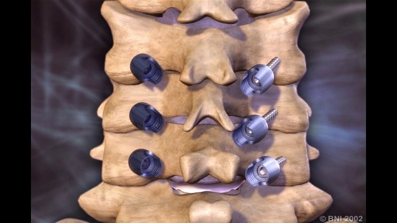 Cervical Lateral Mass Screws