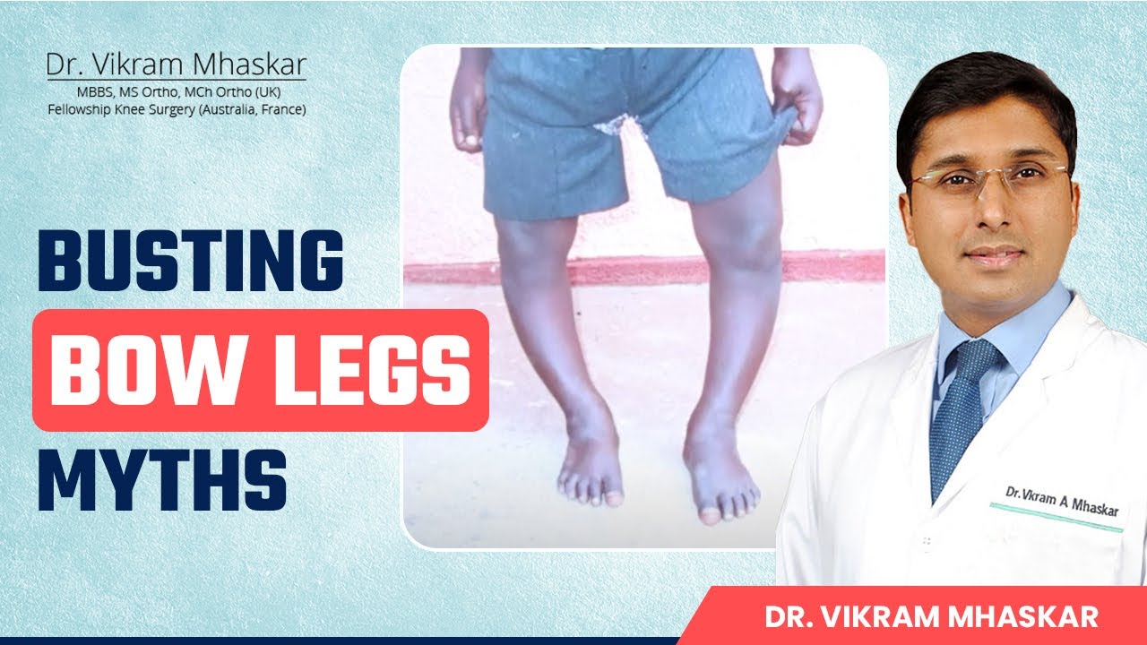 Bow Legs Myths का खुला राज | Busting Bow Legs Myths | Dr. Vikram Mhaskar