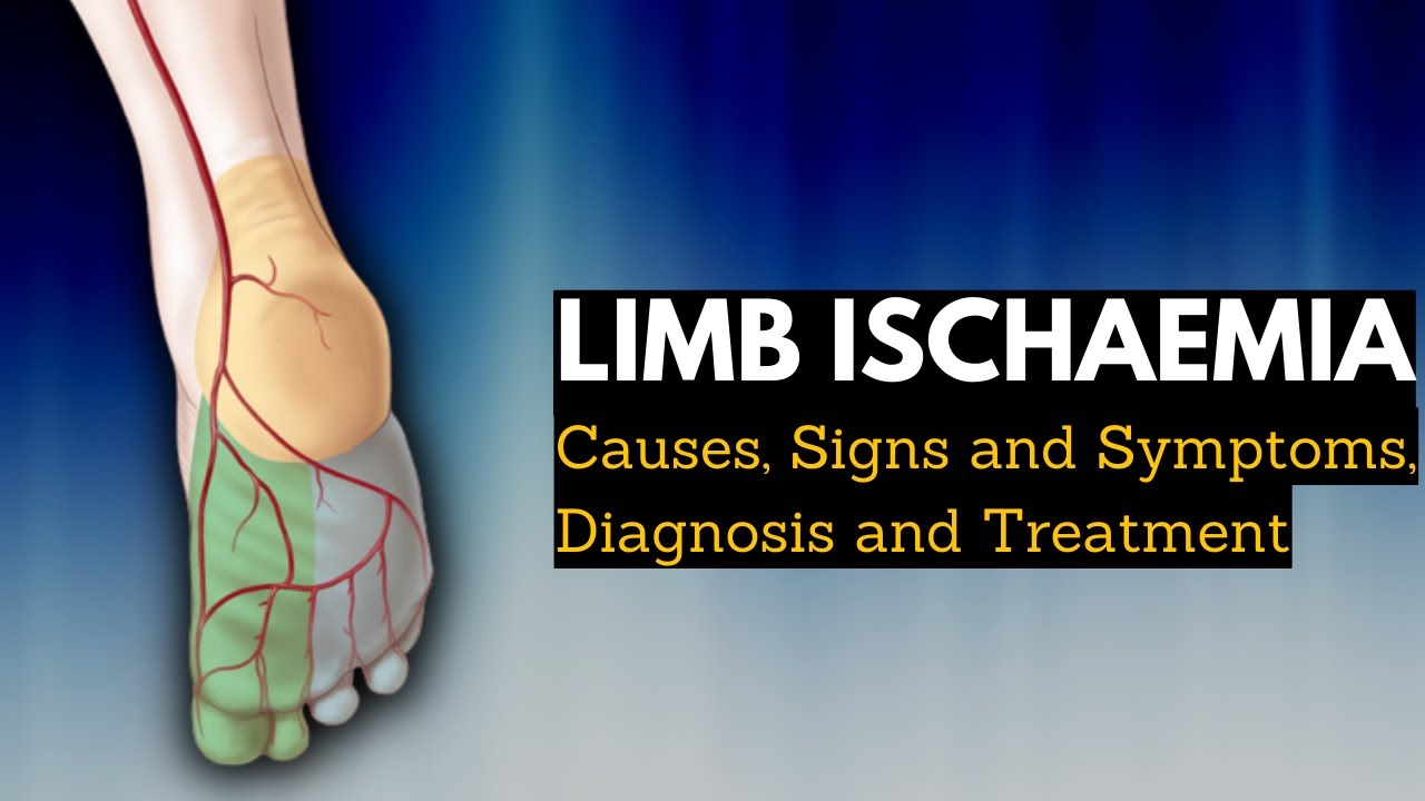 Limb Ischaemia , Causes, Signs and Symptoms, Diagnosis and Treatment.