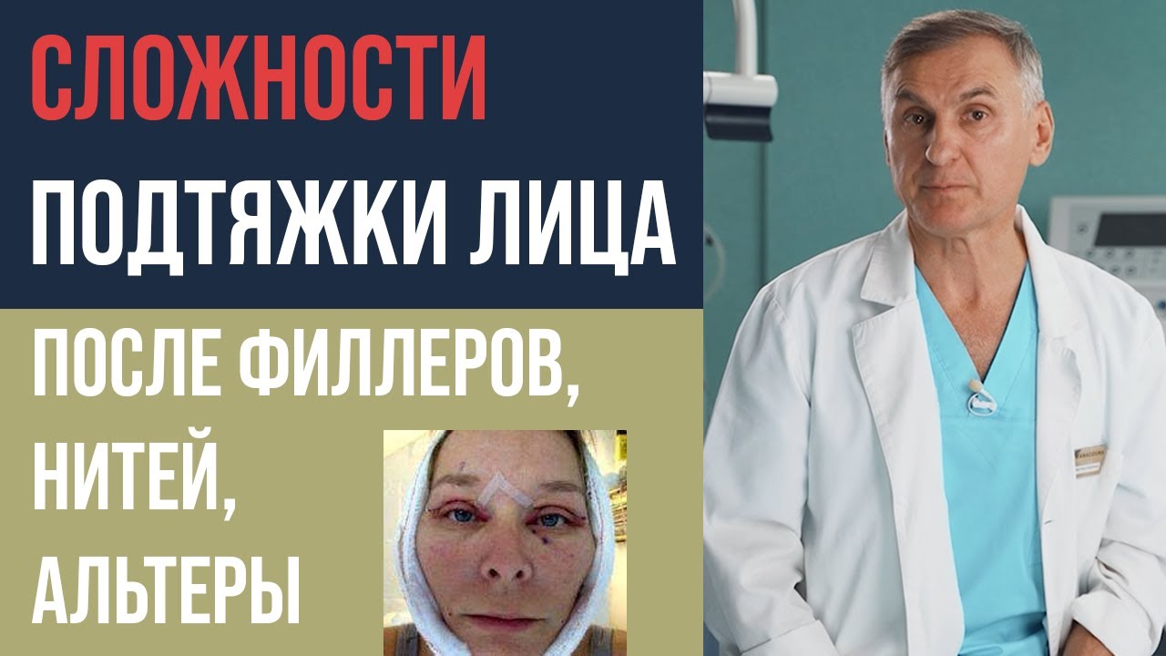 КРУГОВАЯ ПОДТЯЖКА ЛИЦА 🤕  СМАС ПОДТЯЖКА ПОСЛЕ ФИЛЛЕРОВ, НИТЕЙ, АЛЬТЕРЫ?