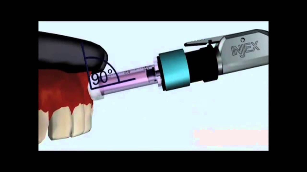 Anestesia dent&aacute;ria sem agulha consultorio em Belo Horizonte (31) 3271-0488