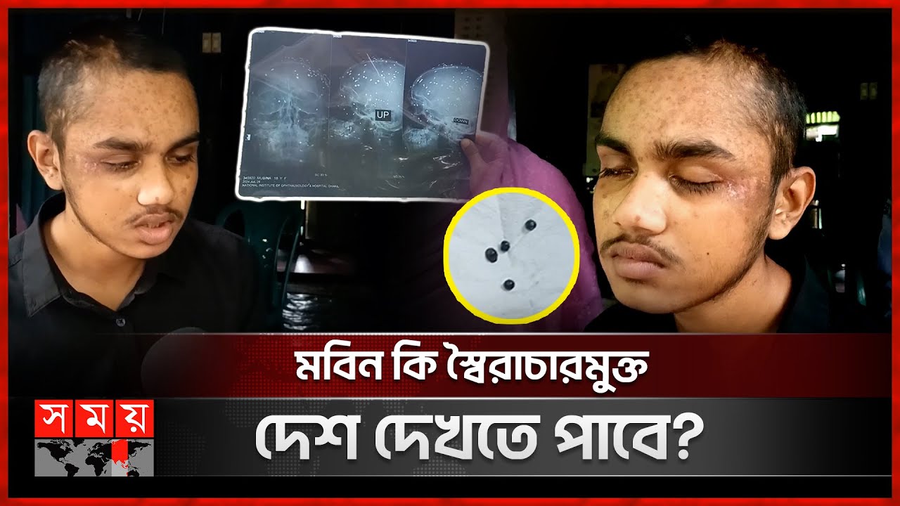 মাথার ভেতর গুলি; চোখে আলো নেই, অর্থাভাবে চিকিৎসা বন্ধ | Quota Movement | Shariatpur News | Somoy TV