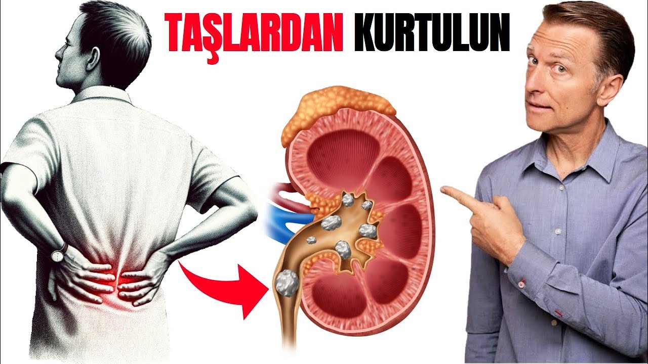 Böbrek Taşlarına Son: Oksalatlardan Kurtulma Yolları | Dr.Berg Türkçe