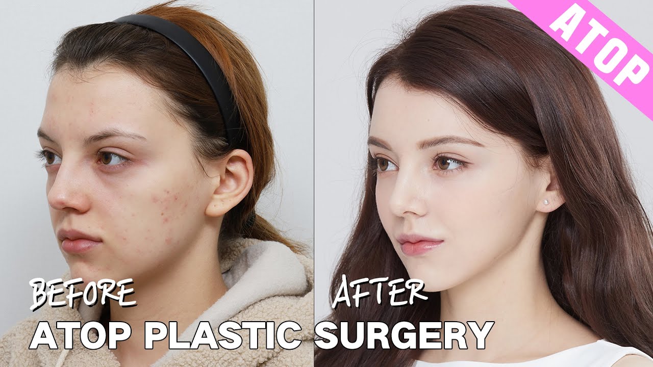 3 Surgeries in ONE DAY! Rhinoplasty and More at ATOP Plastic Surgery Korea