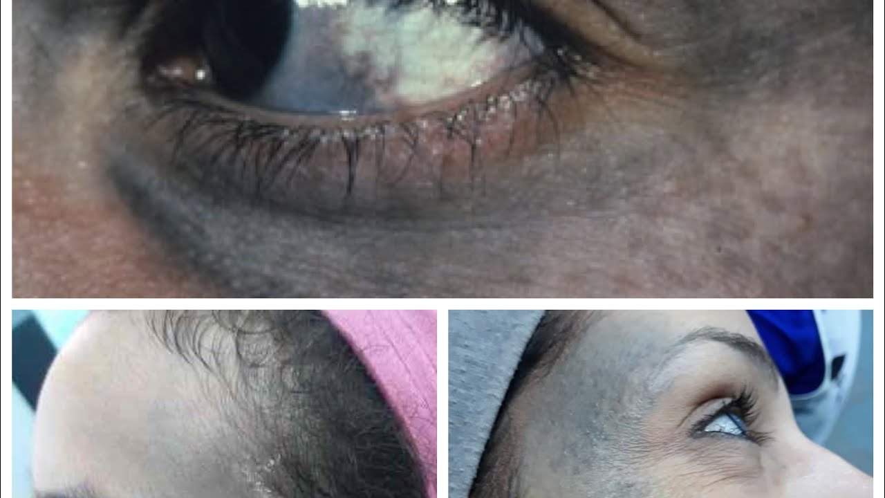 وحمة اوتا Nevus of ota شكلها اية ؟؟؟ويا تري لها علاج ؟؟؟يلا نستفيد ونعرف مع بعض 🛎