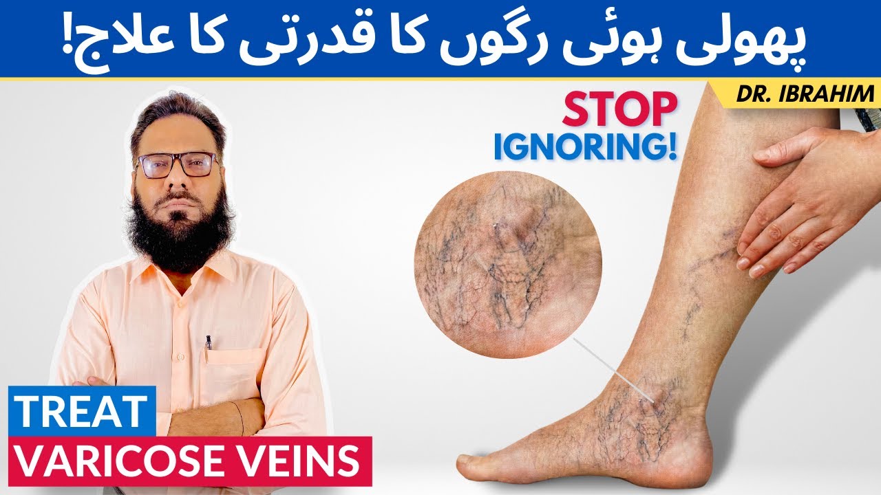 Varicose Veins Ka Qudrati Ilaj - Treat Varicose (Spider) Veins Naturally - Urdu/Hindi - Dr. Ibrahim