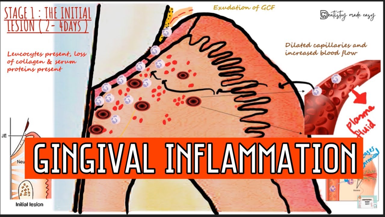 GINGIVAL INFLAMMATION II STAGES OF GINGIVITIS II *Imp