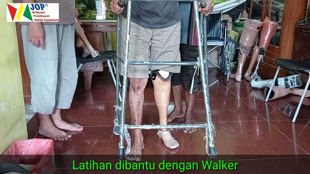 Amputasi sebab Diabetes Bisa Jalan Lagi Pakai Kaki Palsu | JOP official