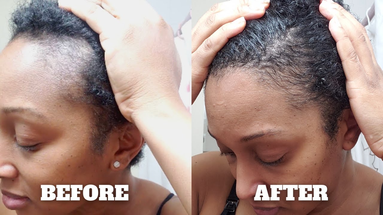 How I Grew My Edges Back Using Wild Growth Hair Oil