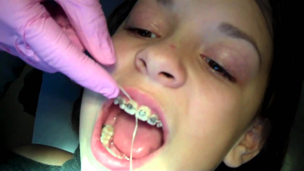How to floss with braces by Orthodontist in Rogers, AR