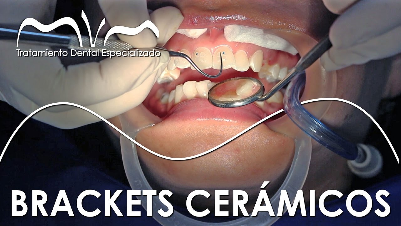 MONTAJE DE BRACKETS | CEMENTACIÓN BRACKETS CERÁMICOS