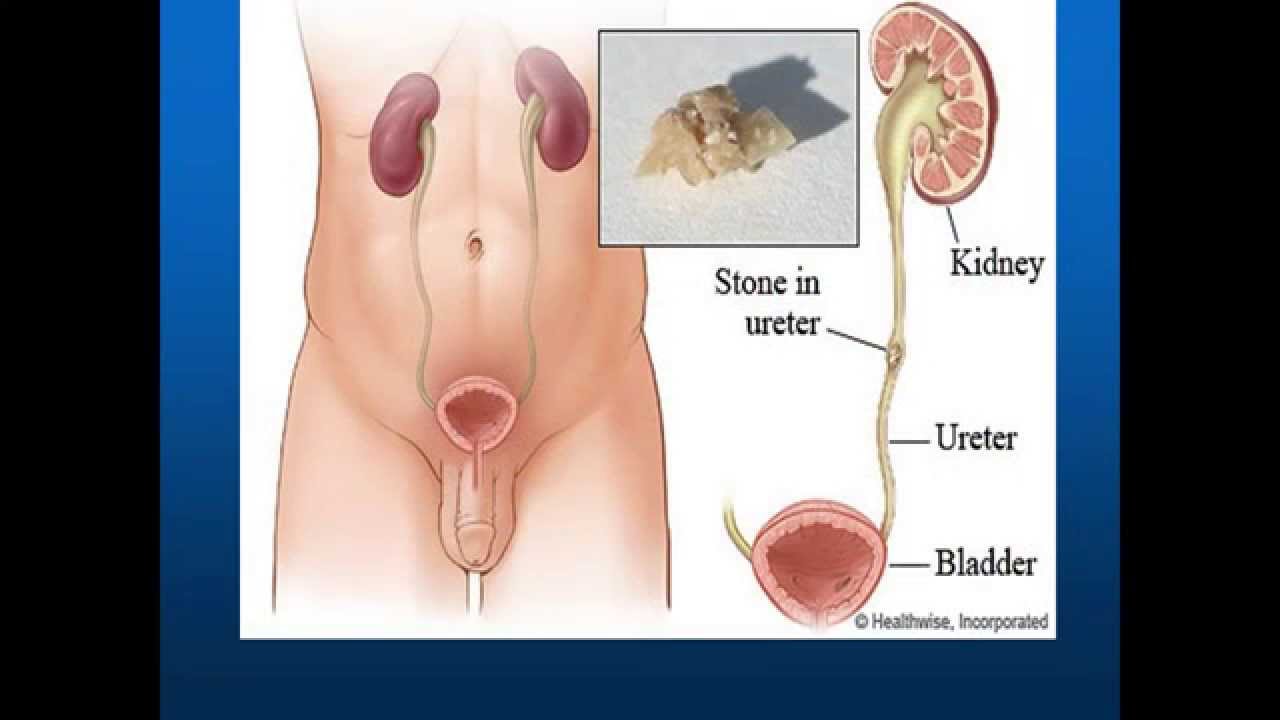 Comprehensive Kidney Stone Management stones504
