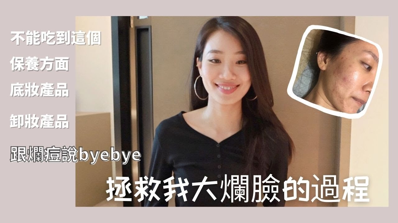 ezskin 保養心得，陳皮靠腰懶人包，從國中開始痘痘就跟著我一輩子的抗痘歷程⎟Stephy Daily