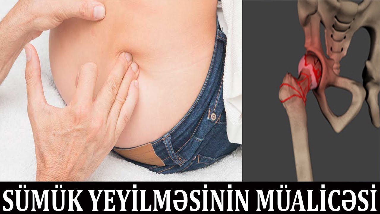 S&uuml;m&uuml;y&uuml; əriyən adamı Azərbaycanlı həkim belə xilas etdi - Avaskulyar nekroz xəstəliyi
