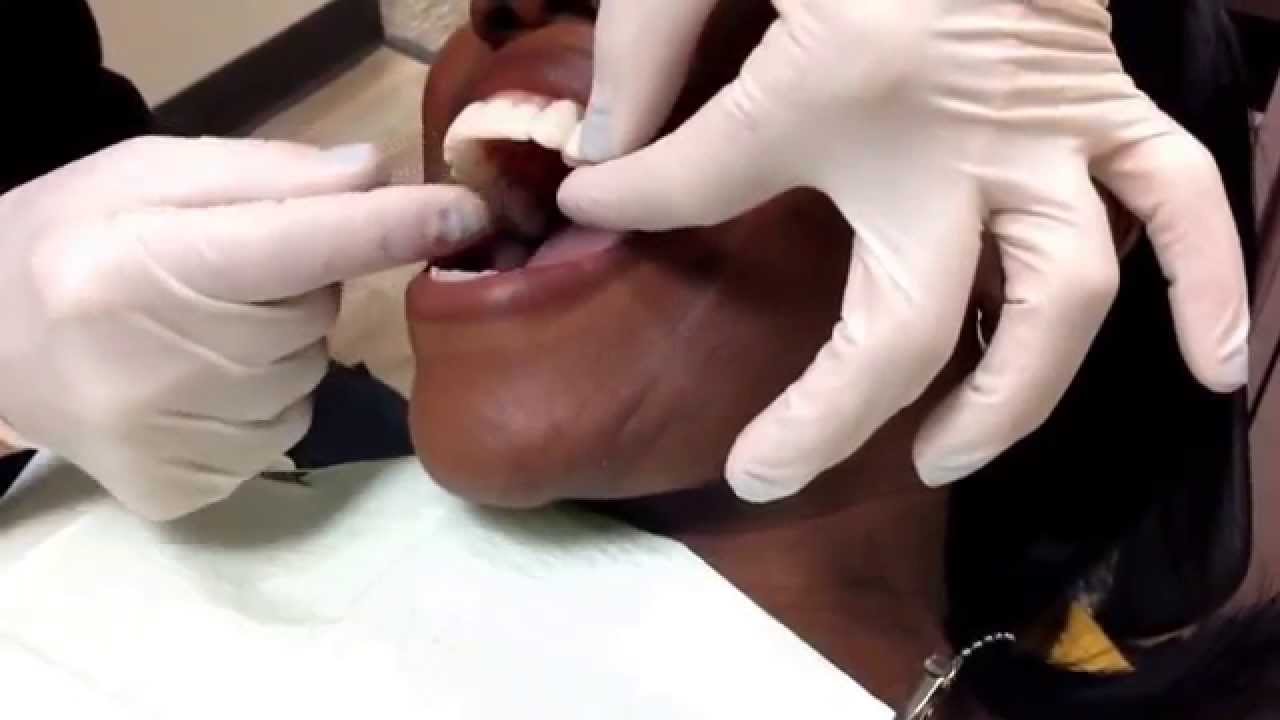 Houston Cosmetic Dentist..WoW! How to correct peg laterals with a Snap-on Smile!