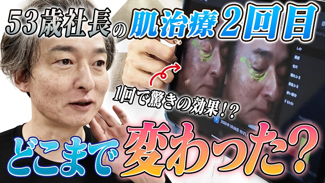 【劇的変化】50代のシミ・シワが1回でここまで！？名古屋・錦の美容皮膚科で「若返り」に挑戦！