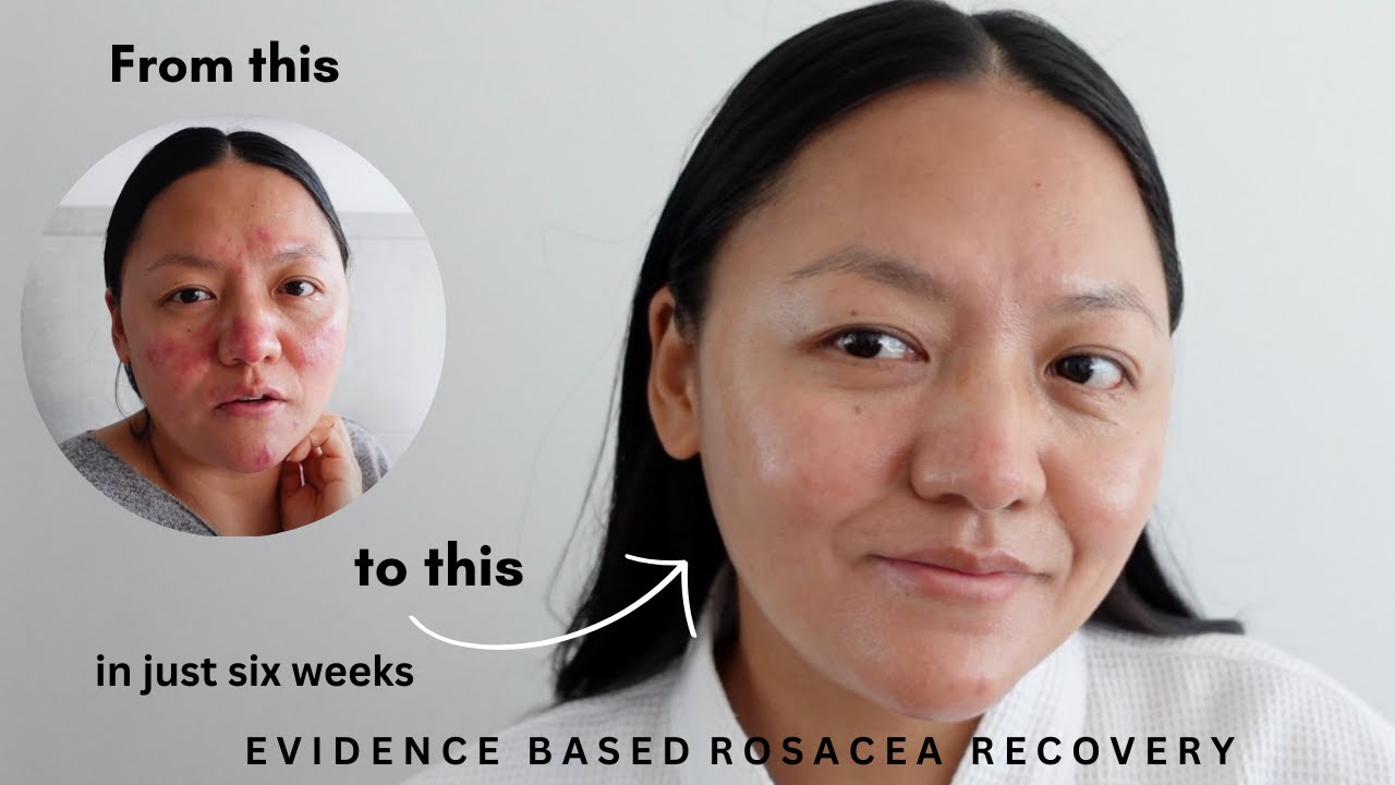 I cleared my rosacea in just 6 weeks with skincare ⎜Raw vlog with evidence based results