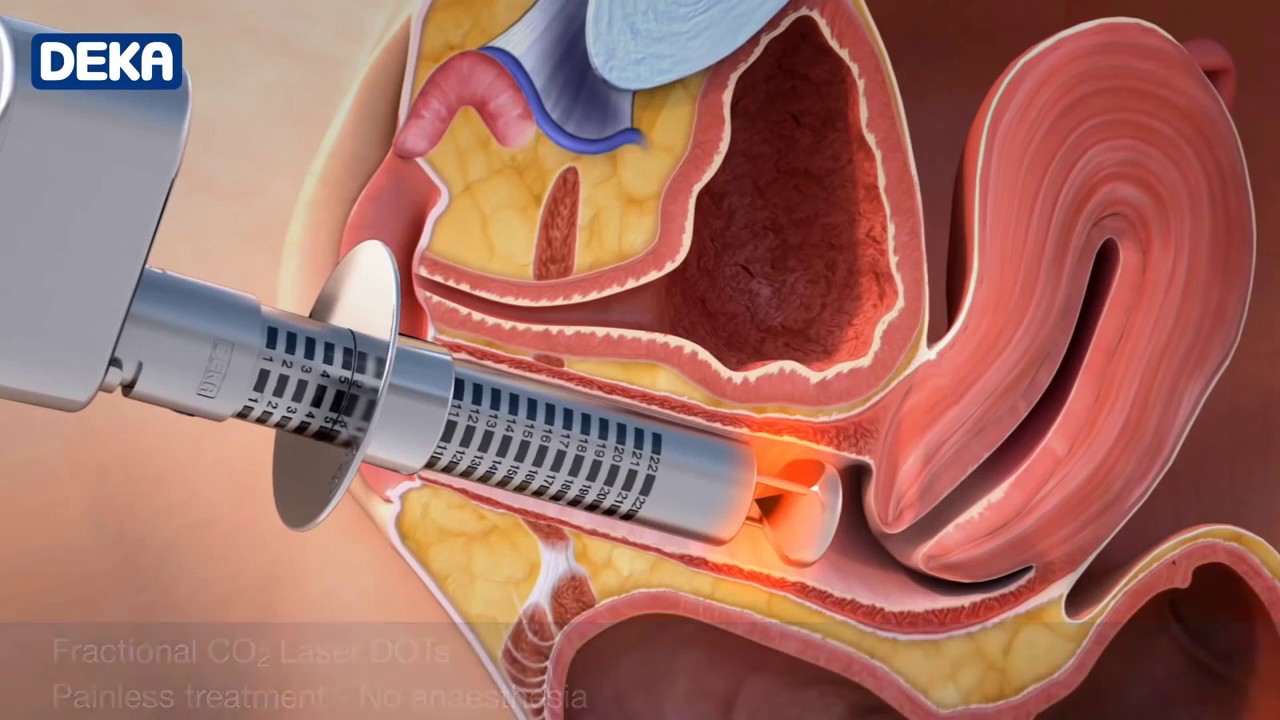 MonaLisaCarolina.com | New Laser Treatment Against Vaginal Atrophy, Laxity, and Urinary Incontinence