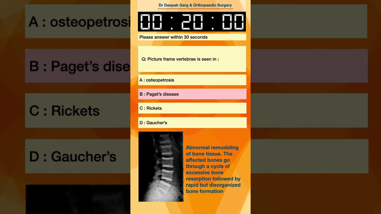 MCQs on Picture Frame Vertebra: #74 | Important for 