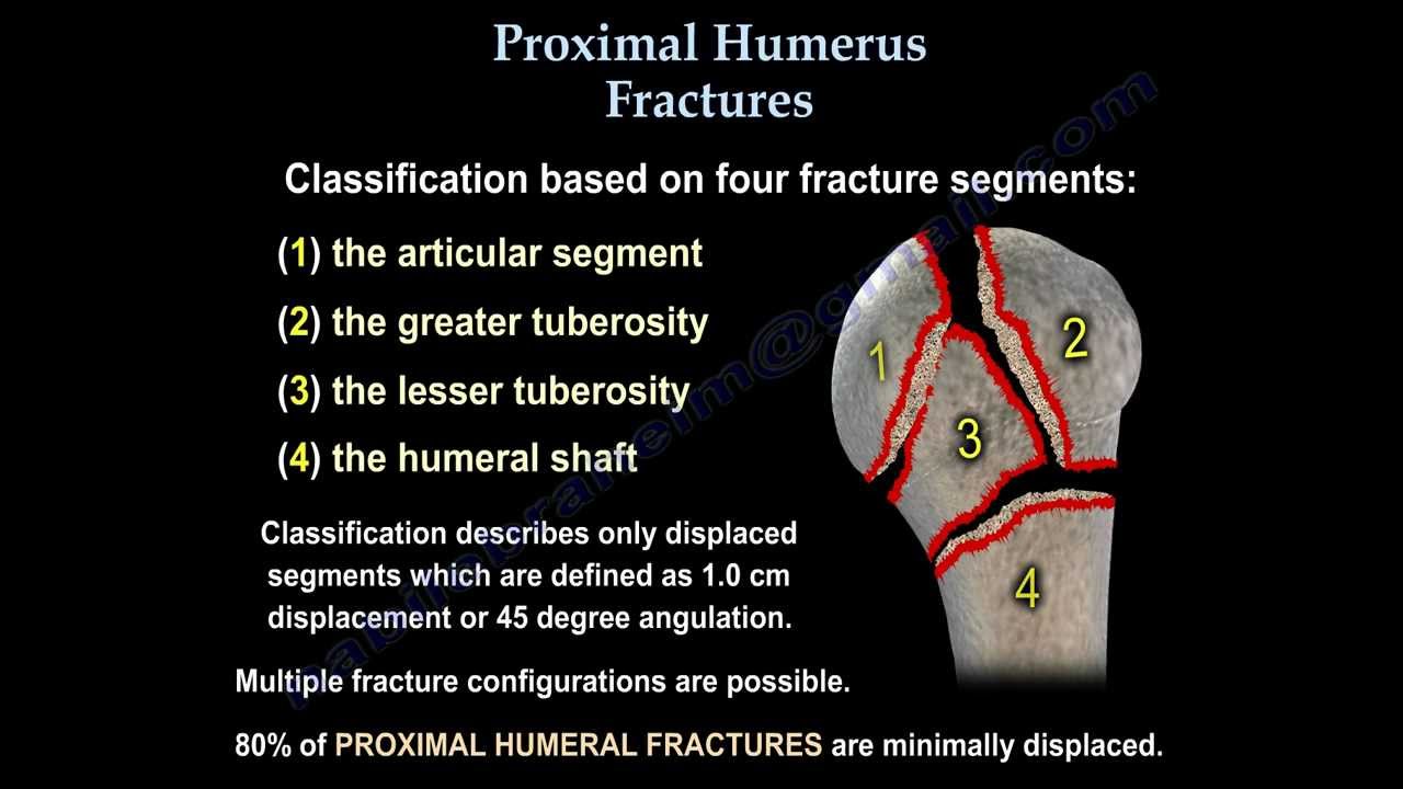 Proximal Humerus Fractures classification - Everything You Need To Know - Dr. Nabil Ebraheim