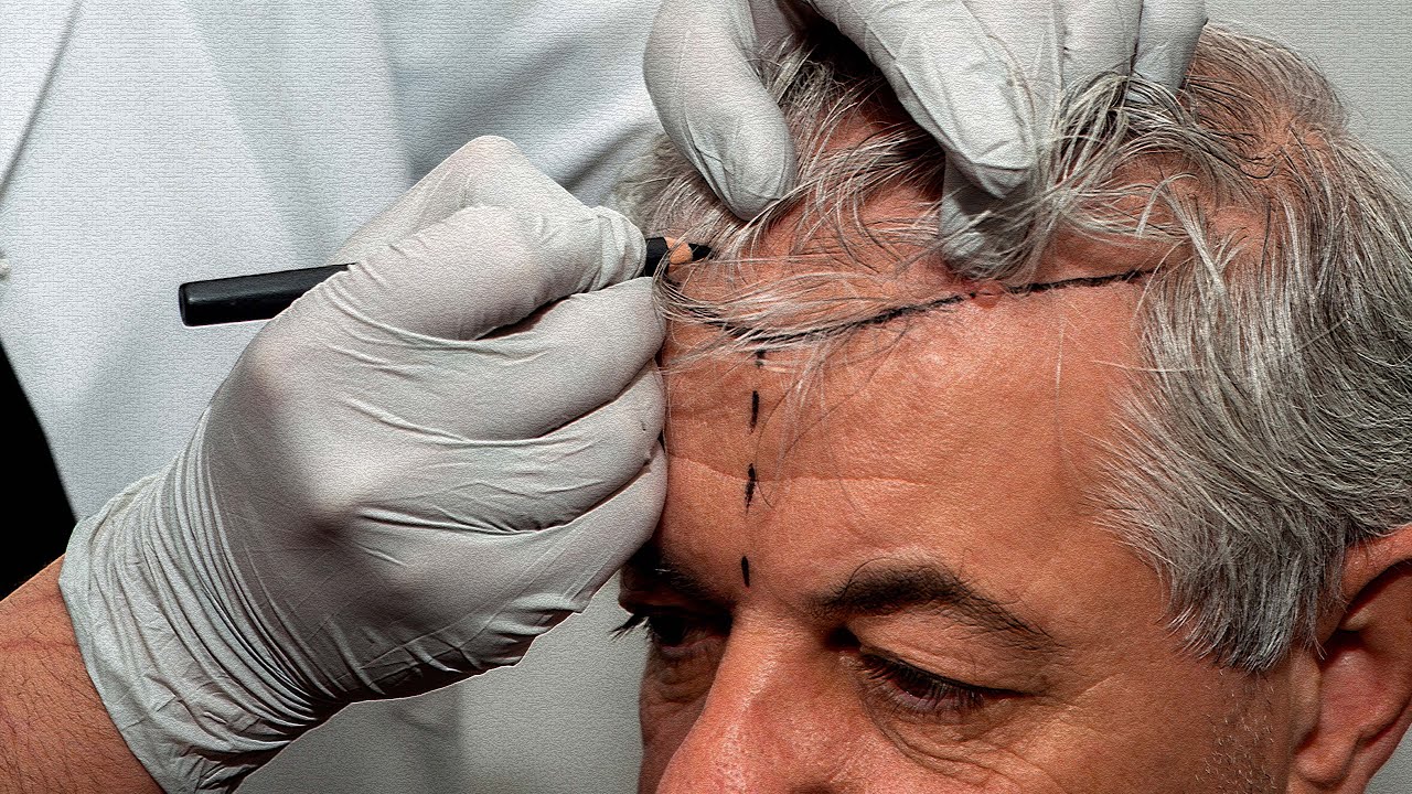 How many grafts to restore hairline ?