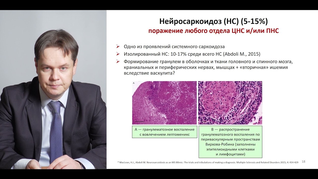 Нейросаркоидоз. Краснов Владимир Сергеевич, доцент кафедры неврологии, к.м.н..