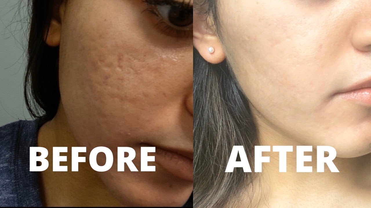 MY CO2 LASER RESURFACING TREATMENT EXPERIENCE | how to get rid of acne scars & hyperpigmentation
