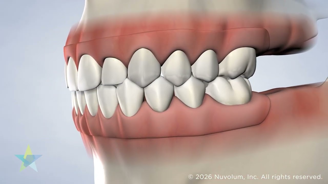What is Full-Arch Restoration in Dallas, TX?