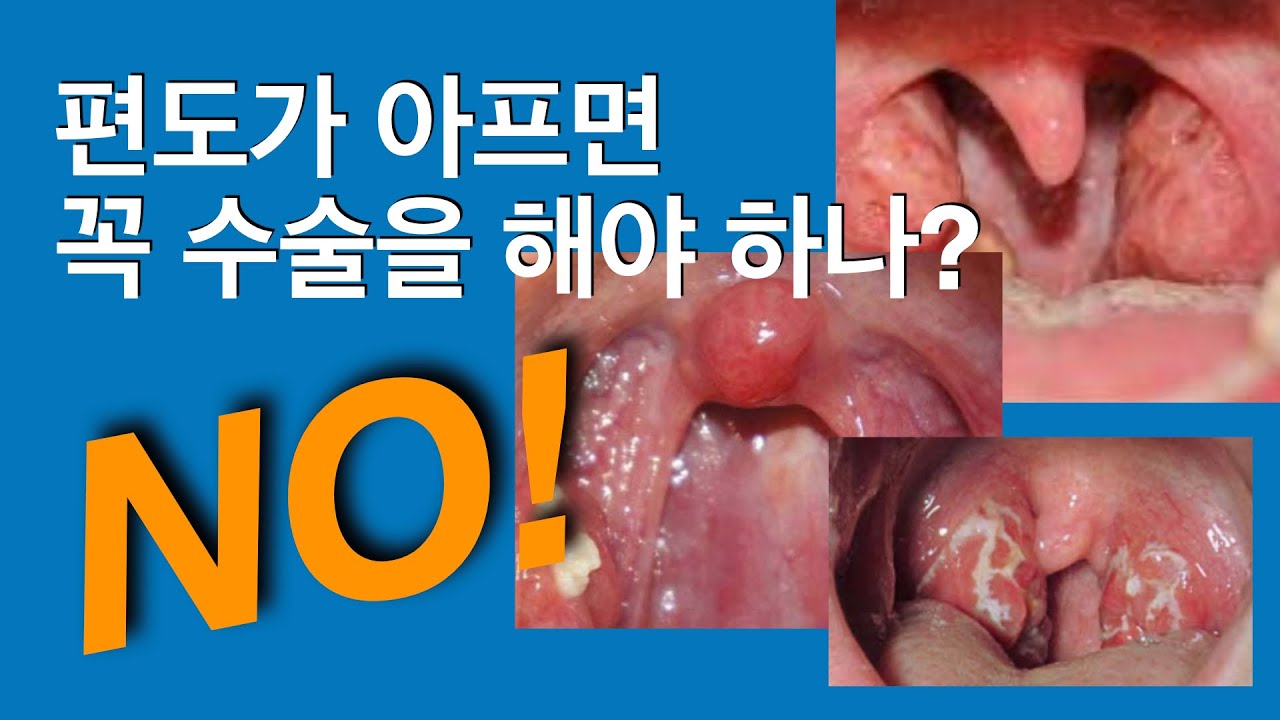 편도결석, 꼭 수술해야 할까요?