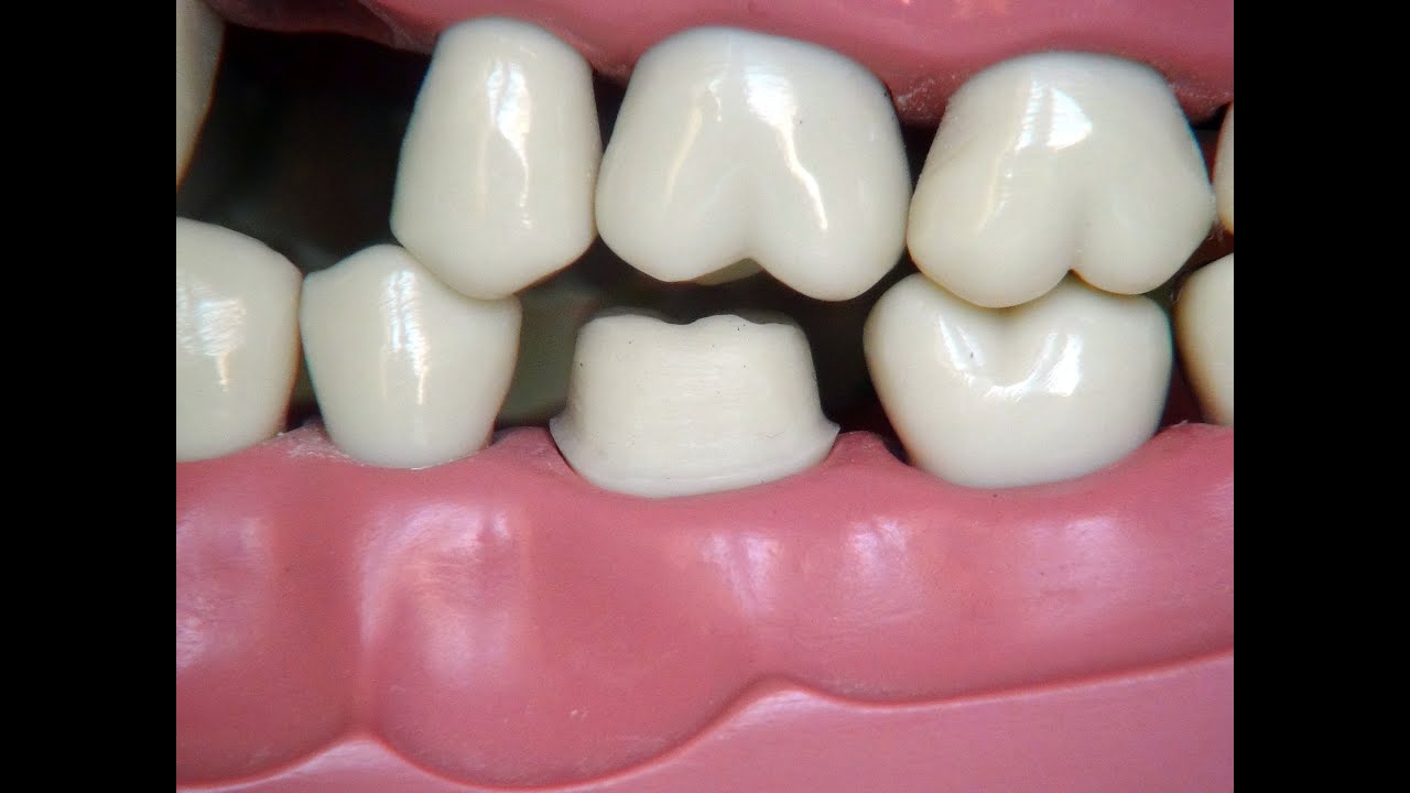 Full metal crown preparation - for dental students