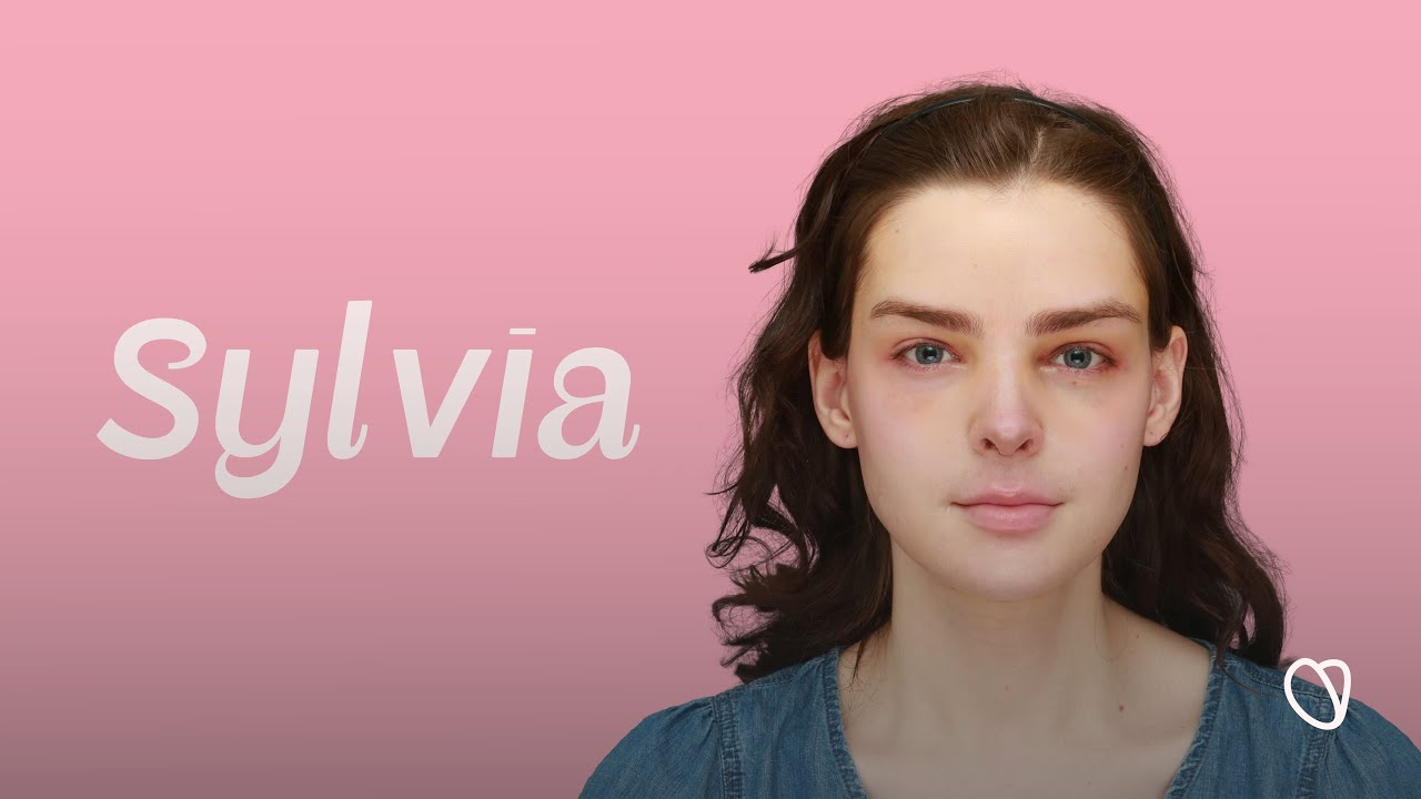 Sylvia, United States — Facial Feminization Surgery Before and After