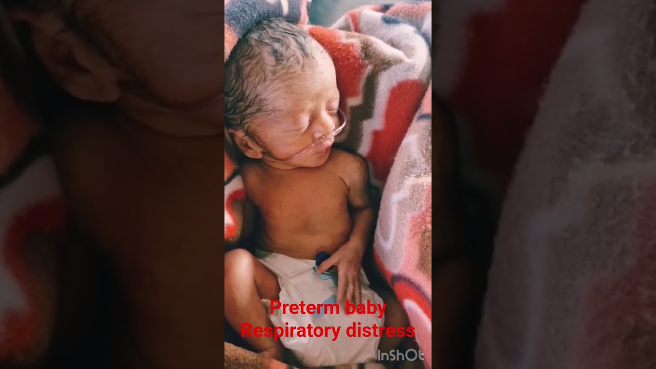 #pretermbaby#LBW#babygirl#newborn#cutebaby#oxygenby nasalpronge#babycare#comeinnicu