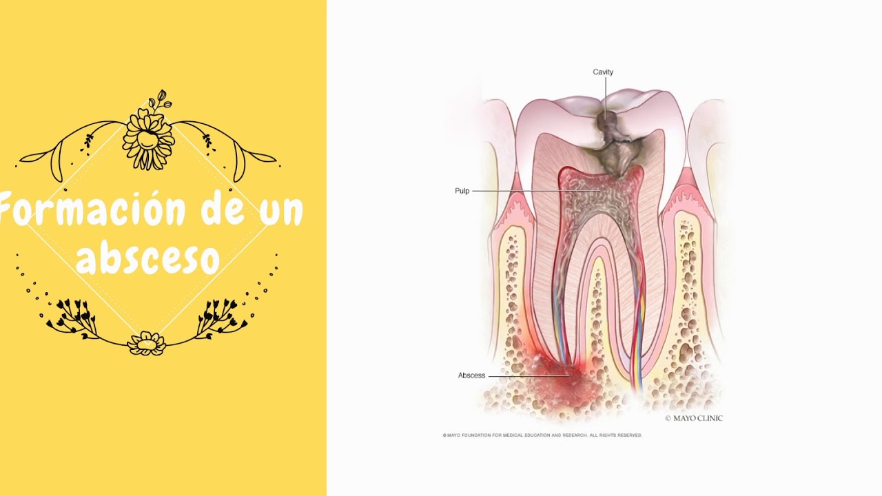 CARIES DE DENTINA