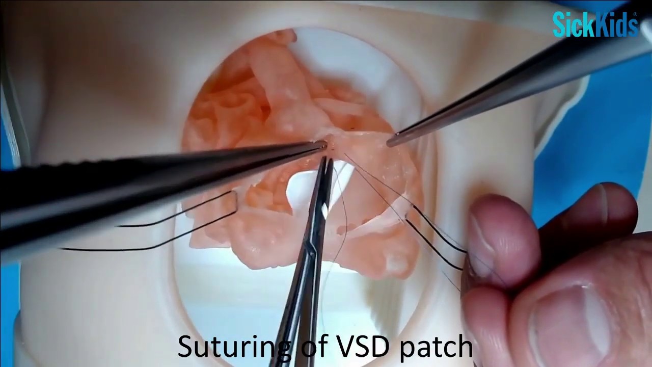 HOST - Single-stage Taussig-Bing repair (ASO+VSD closure+Ao reconstruction) on 3D-printed model