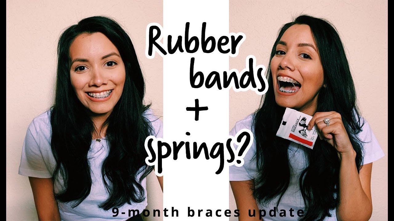 RUBBER BANDS + SPRINGS | 9-month braces update