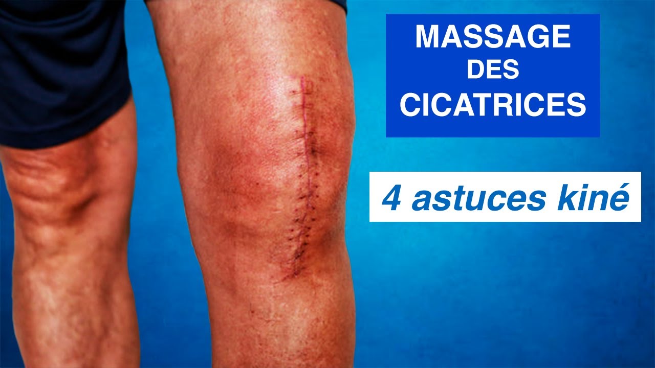 MASSAGE DES CICATRICES : 4 Astuces + Conseils kiné
