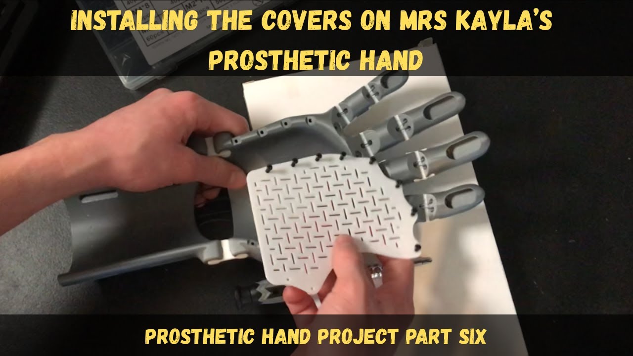 Installing the covers on Mrs. Kayla's prosthetic hand/ Prosthetic hand project part six