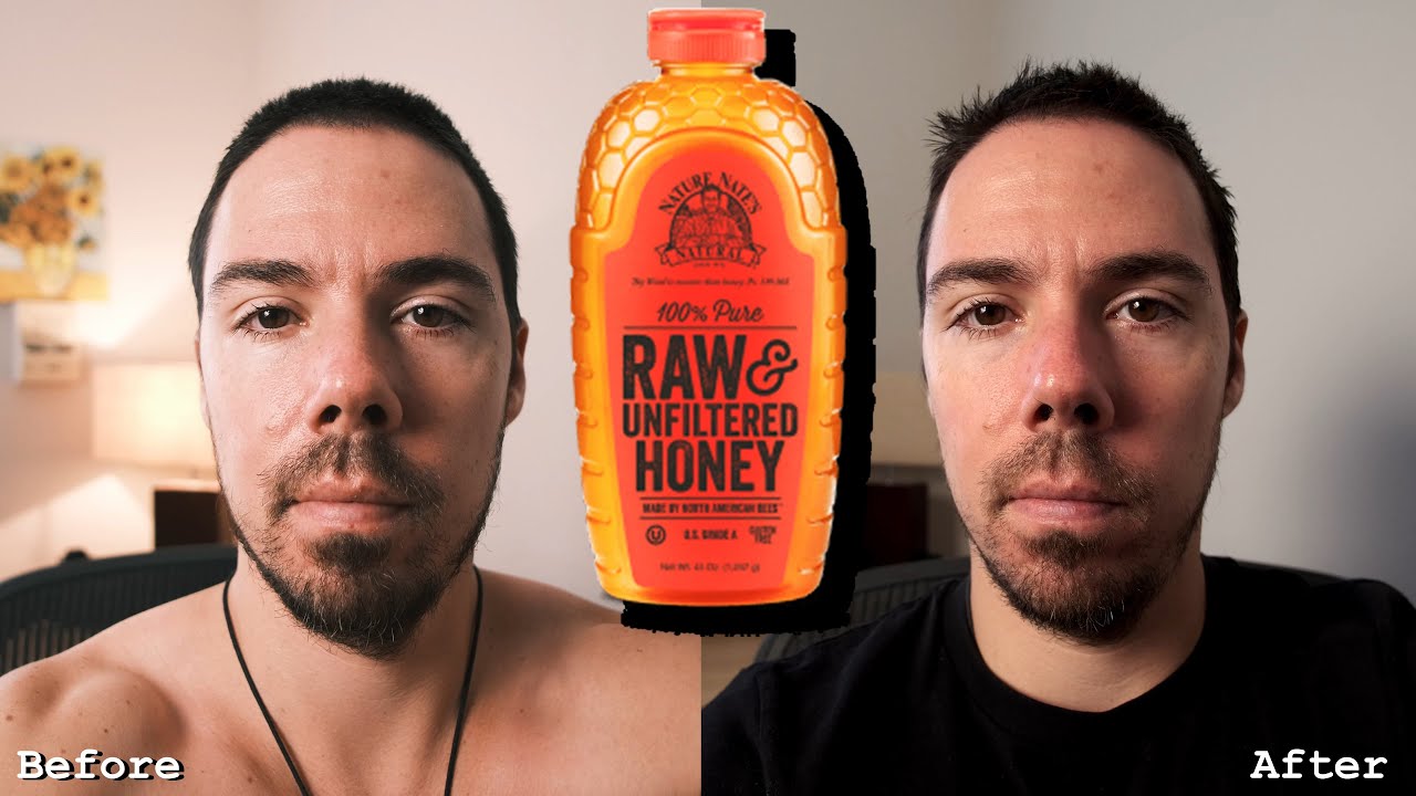 Treating Fungal Acne With RAW Honey (2 Week Results)