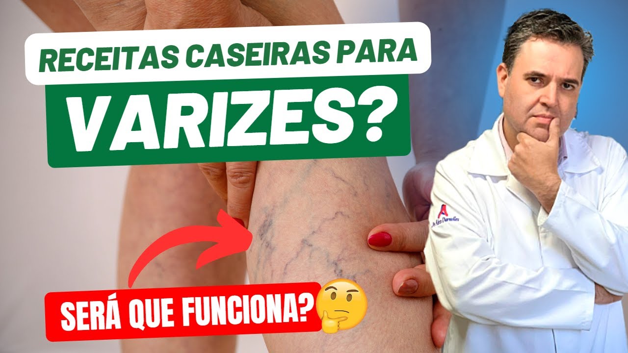 RECEITAS CASEIRAS  para eliminar VARIZES, funciona? Dr. Alex Vascular