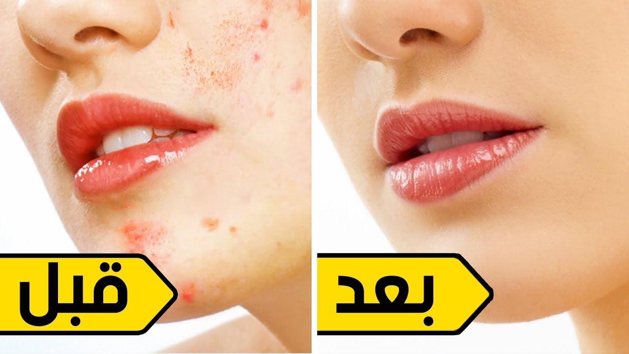 سيساعدك هذا على التخلص من آثار حب الشباب في أربعة أيام