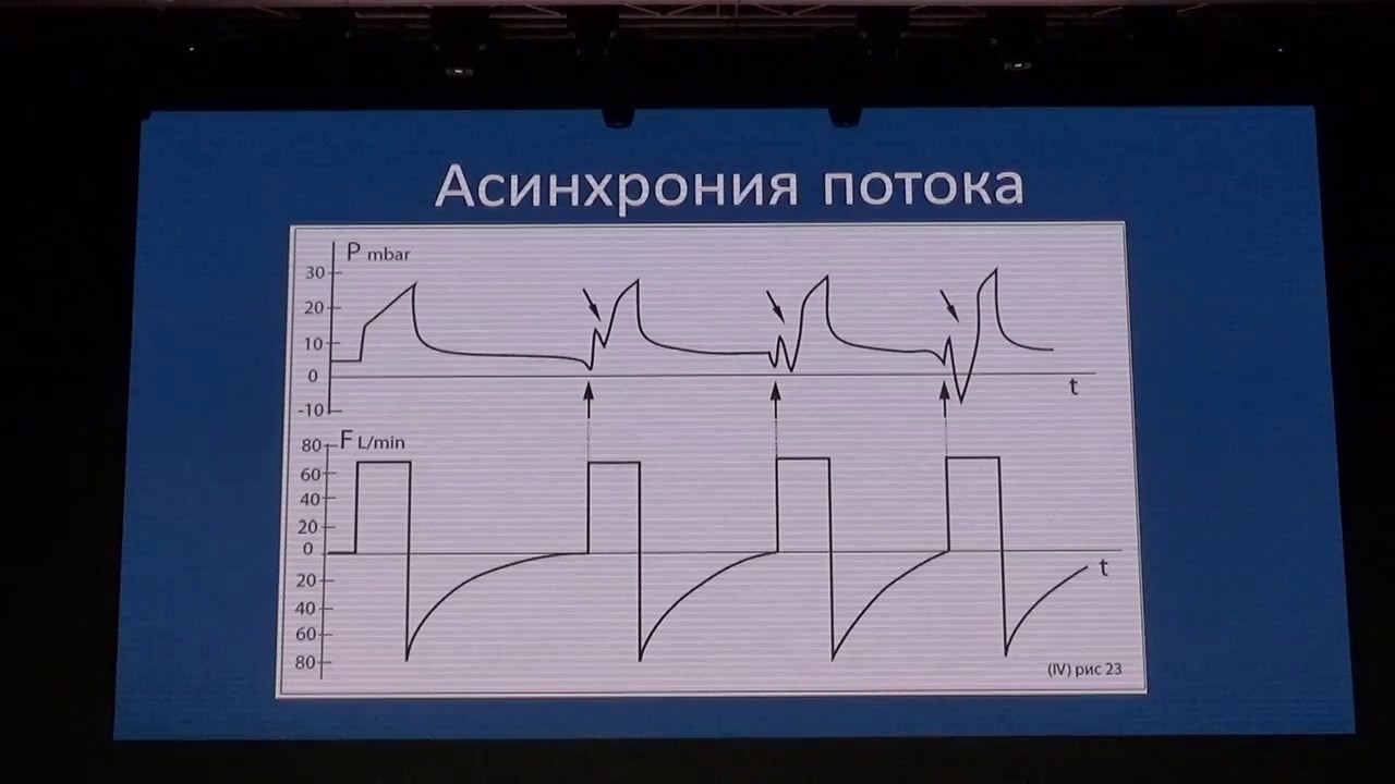 Ассинхрония пациента и аппарата ИВЛ Полупан А.А.