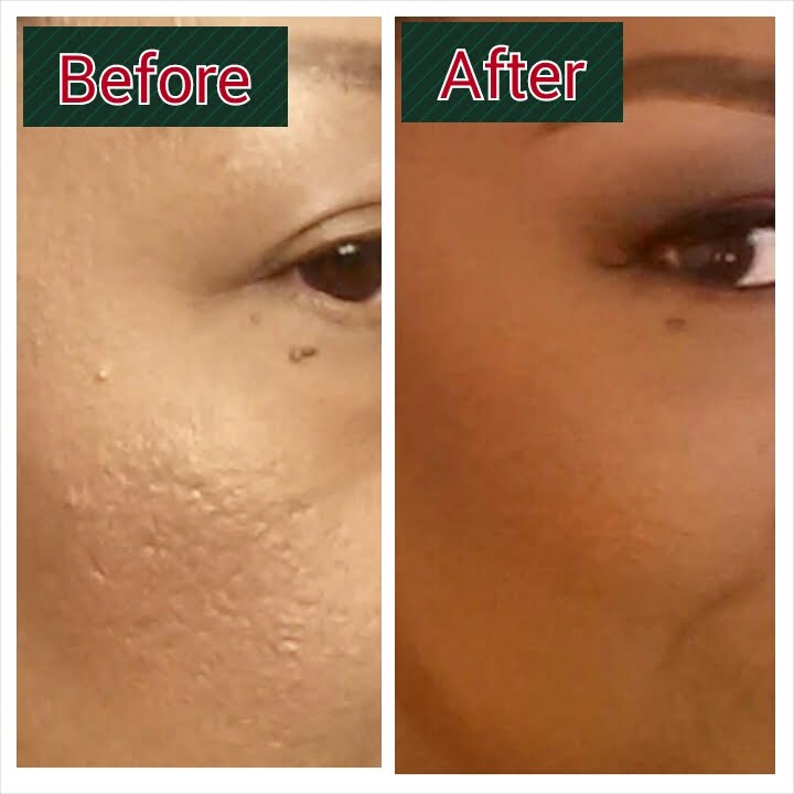 ( Pain in the ASS !! ) Pitted Acne Scars...How i minimize appearance with foundation