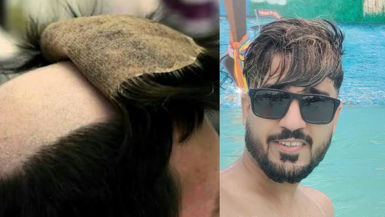 Must watch, swimming with hair patch, by anas sheik, consultant at WhatsApp 9650914665 and call also